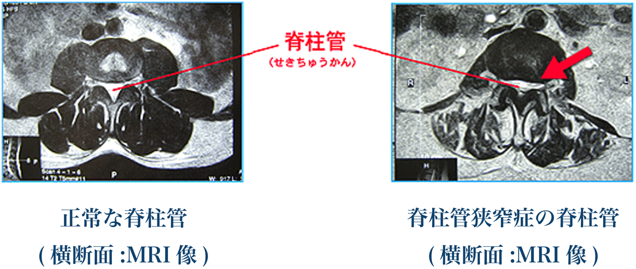 正常な脊柱管と脊柱管狭窄症の脊柱管のMRI画像