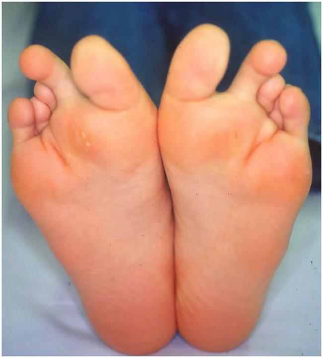 中足骨短縮症の足の画像