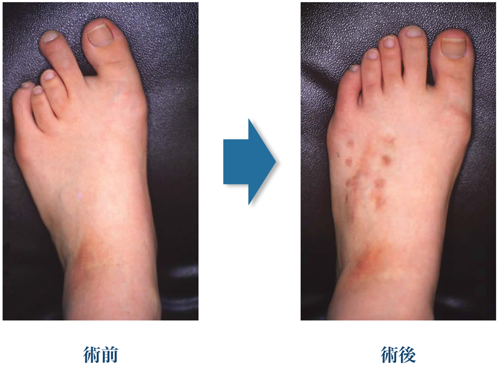 中足骨短縮症の手術前後の比較画像