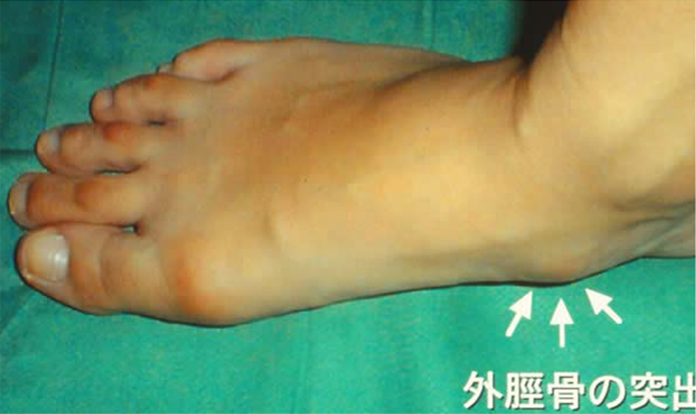 有痛性外径骨の画像