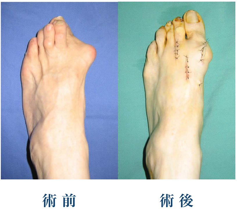 外反母趾の手術前後足を上から撮影した画像
