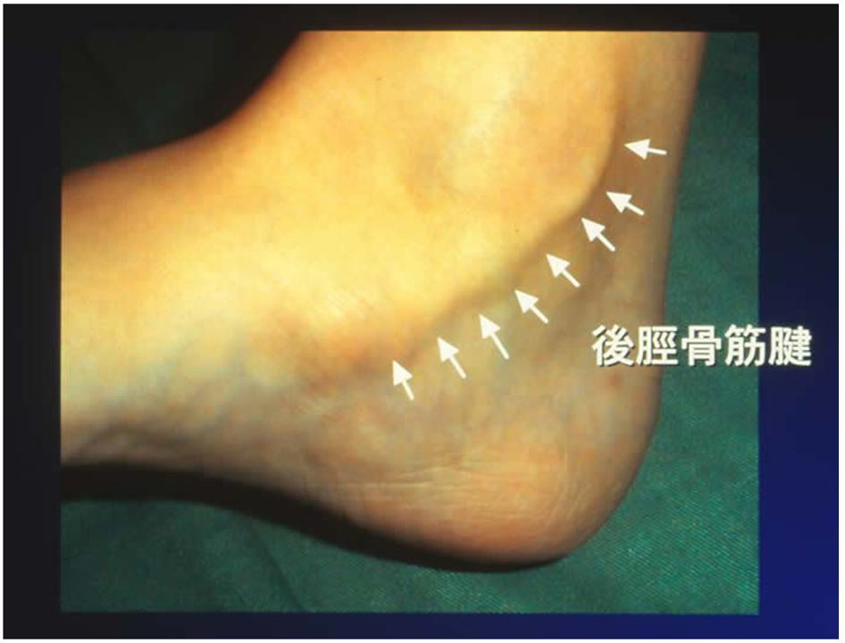 有痛性外脛骨の手術後の写真