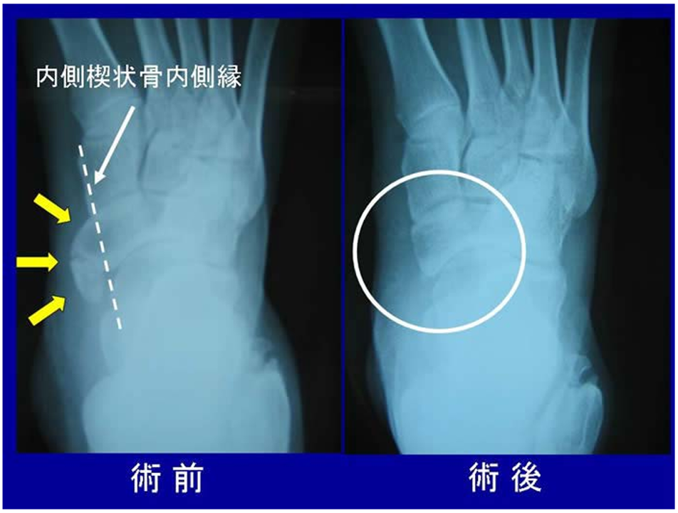 VeitchⅡ型の外脛骨の患者様の術前術後のレントゲン写真