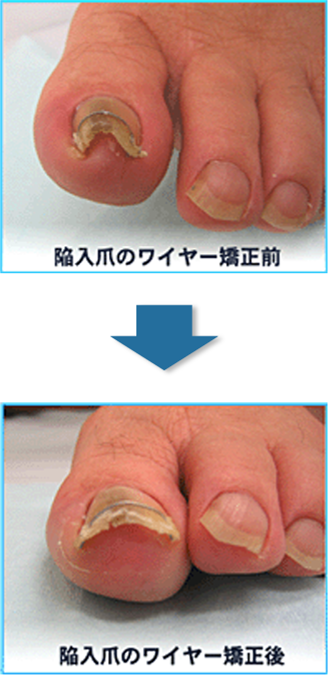 足の親指の陥入爪のワイヤー矯正前と後の比較画像