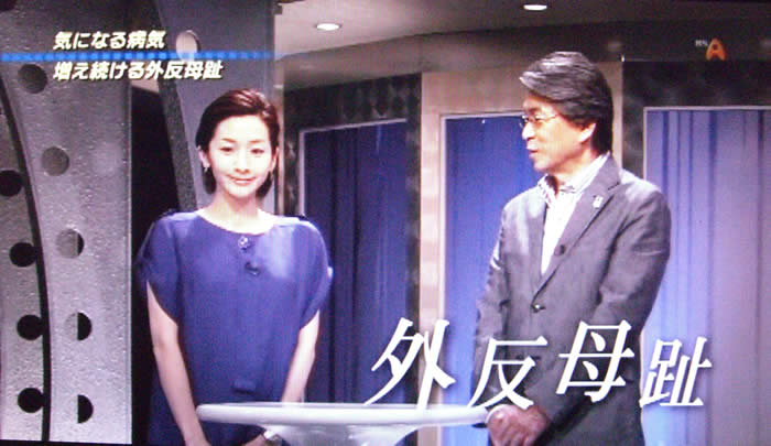 (番組キャプチャ)鳥越さんと女性キャスターが話している。画面右下に「外反母趾」のテロップ