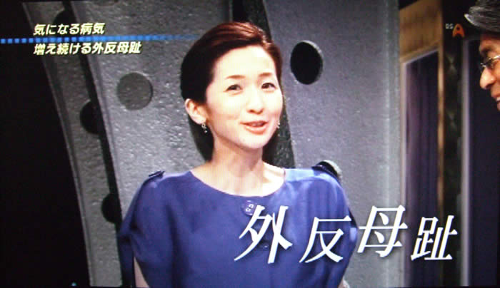 (番組キャプチャ)女性キャスターが話す姿がアップで映される。画面右下に「外反母趾」のテロップ