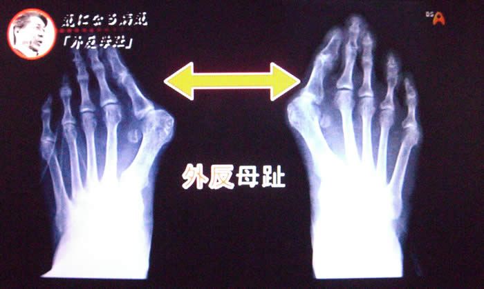 (番組キャプチャ)外反母趾のレントゲン画像