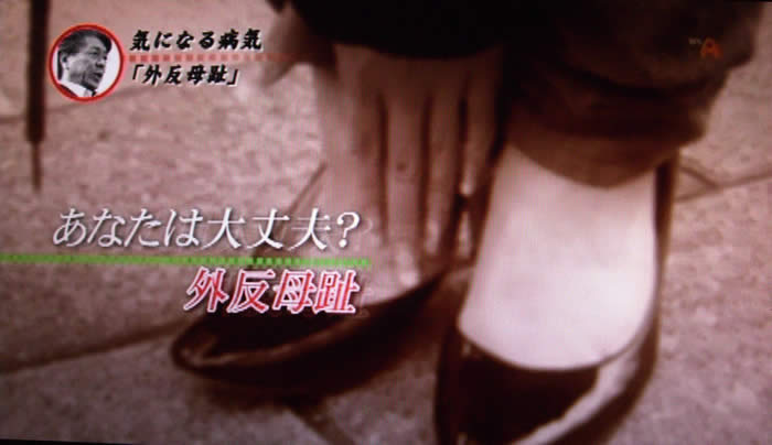 (番組キャプチャ)パンプスを履いた女性の足元がアップの背景に、あなたは大丈夫?外反母趾のテロップが表示