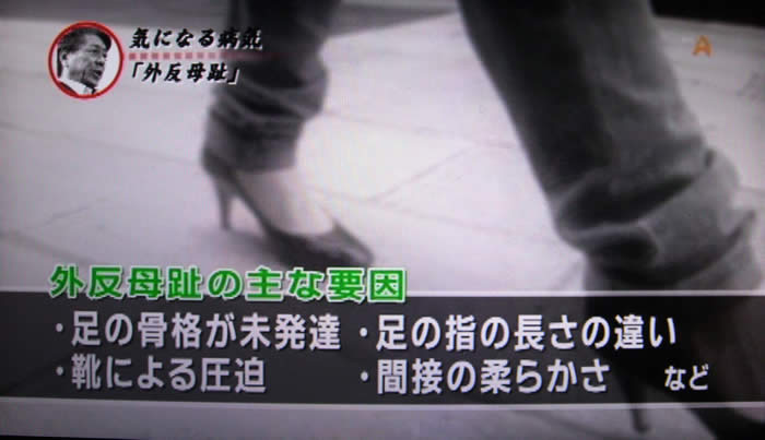 (番組キャプチャ)外反母趾の主な要因・足の骨格が未発達・足の指の長さの違い・靴による圧迫・関節の柔らかさ など というテロップ表示