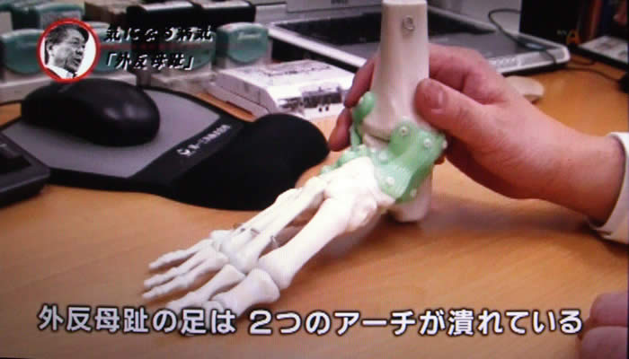 (番組キャプチャ)足の骨の模型を手にした吉野院長の手元がアップで映され、説明をしている「外反母趾の足は2つのアーチが潰れている」