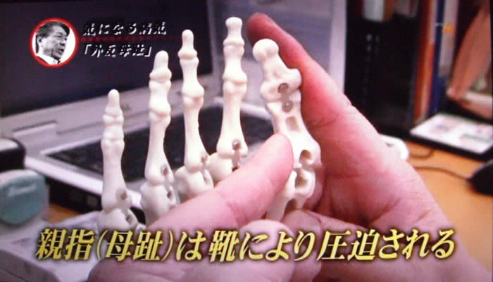 (番組キャプチャ)吉野院長の説明続き「親指(母趾)は靴により圧迫される」