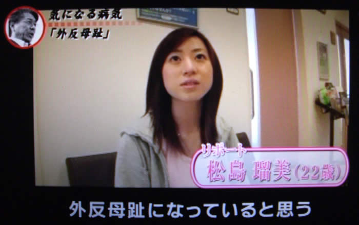 (番組キャプチャ)松島さんが話している「外反母趾になっていると思う」