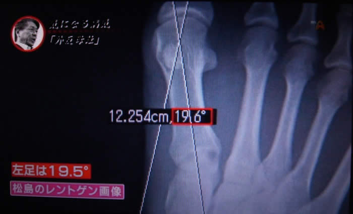 (番組キャプチャ)パソコンでレントゲンの角度を計っている。画面には19.6°と表示されている