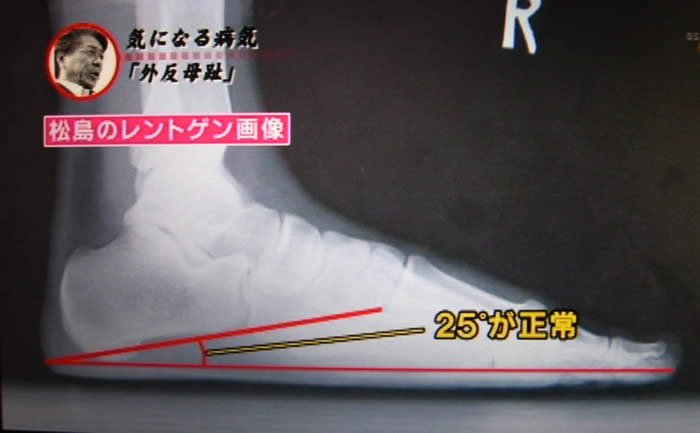 (番組キャプチャ)足を横から撮影したレントゲン写真が表示される。踵の設置面から土踏まずへの角度に線が引かれ、25°が正常というテロップ表示
