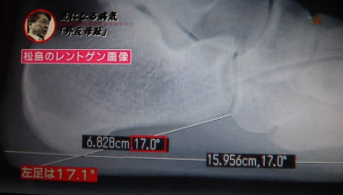 (番組キャプチャ)パソコンでレントゲンの角度を計っている。画面には17.0°と表示されている