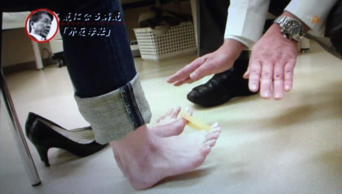 (番組キャプチャ)松島さんが両足の親指を太い輪ゴムで繋ぎ、両足を開いている。吉野院長が手でその動きを説明している